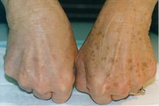 пигментация кожи рук