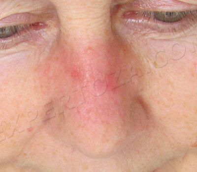 9-я неделя от начала облучения.