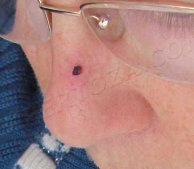 Через неделю после соскоба