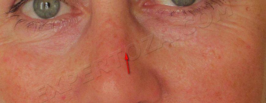 первая базалиома