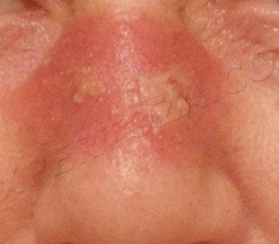 5-я неделя от начала облучения