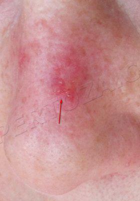 После 2-х недель облучения