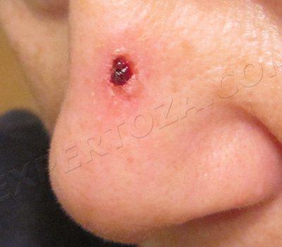 В первый день после соскоба