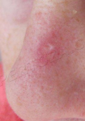 После 1 недели облучения