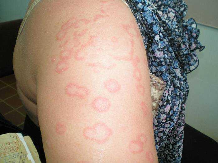 эритема (паранеопластческий синдром)