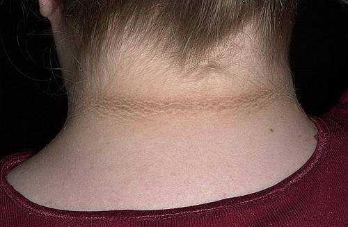 Паранеопластический синдром