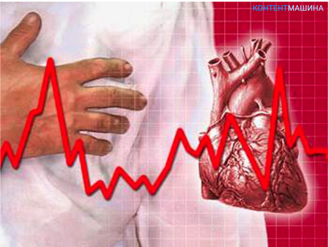 Сердечная аритмия - что это такое и как лечить