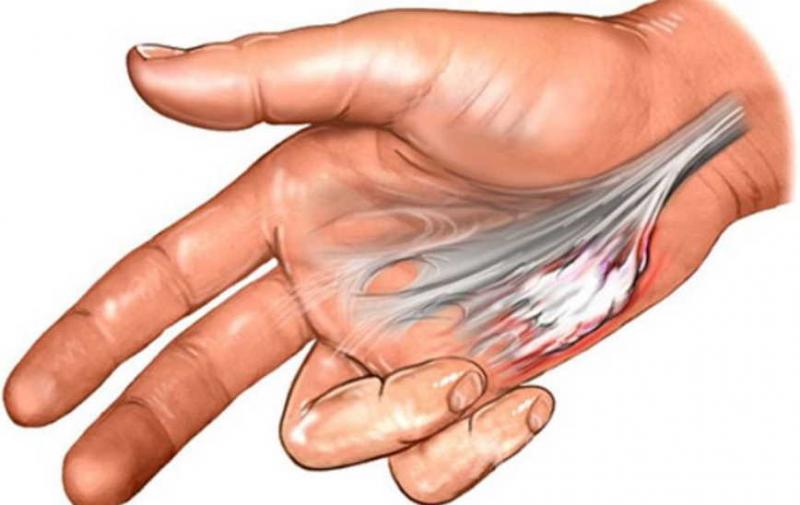 Контрактура мышц рук или ног - народные методы лечения