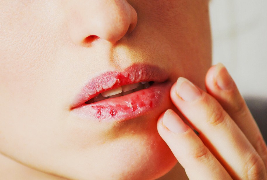 Обветренные губы или хейлит - причины и лечение болезни